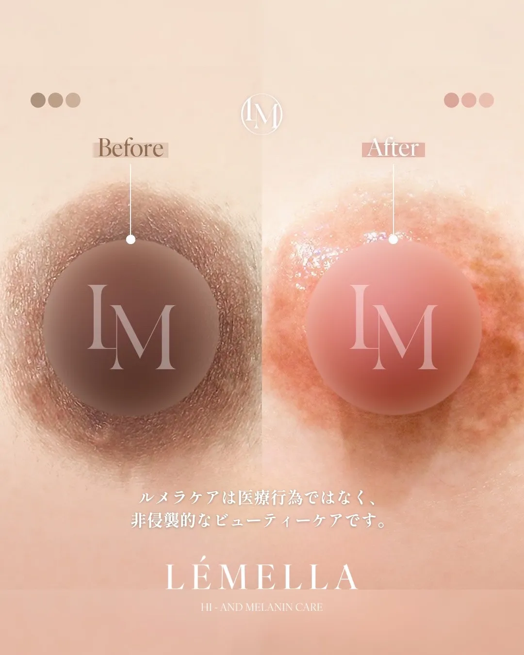ルメラ｜ビフォーアフター（乳輪）
