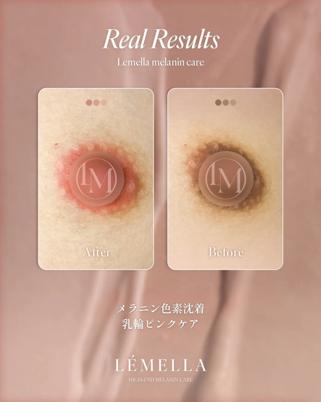 ルメラ｜ビフォーアフター（乳輪）
